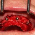 Geko-Situazione-dopo-inserimento-impianti-dentali.jpg
